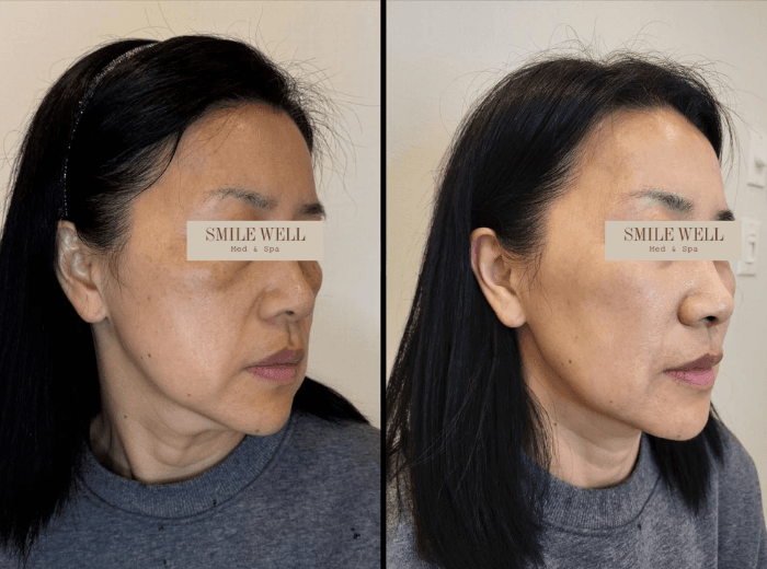 Melasma treatment before and after results at Smile Well Coquitlam